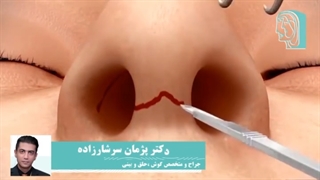 مدت زمان جراحی بینی چقدر است؟