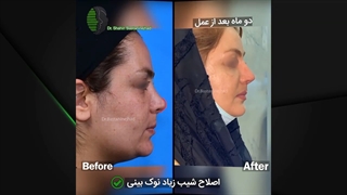 نتیجه جراحی بینی از اتاق عمل تا یکسال بعد | دکتر باستانی نژاد