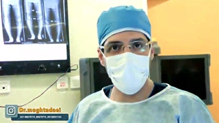 تعویض مفصل زانو در خانم ۶۵ ساله دچار آرتروز شدید