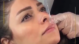تزریق ژل لب روسی