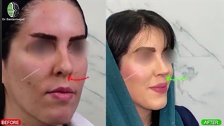 جراحی زیبایی بینی با نوک گرد | دکتر باستانی نژاد