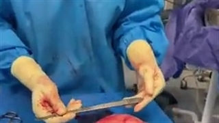 جراحی فیبروم خیلی بزرگ در خانم جوان