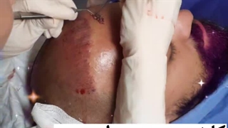 کاشت مو با تراکم بالا 09336093000در گرگان گنبد کردکوی آق قلا