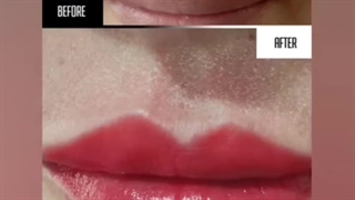 تزریق ژل لب  09336093000در مرکز نگین گرگان