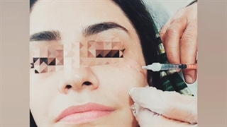 مزوتراپی و مزونیدلینگ صورت 09336093000 در‌ نگین  گرگان