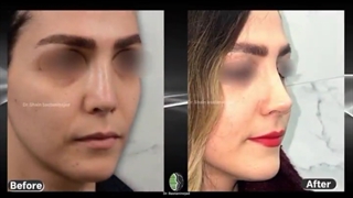 جراحی زیبایی بینی با انحراف شدید | دکتر باستانی نژاد