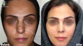 شش ماه پس از جراحی بینی باکسی تیپ | دکتر باستانی نژاد
