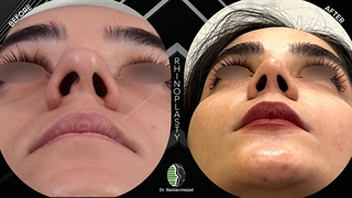 جراحی زیبایی بینی گوشتی و پهن | دکتر باستانی نژاد