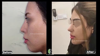 جراحی ترمیمی بینی کوتاه | دکتر باستانی نژاد
