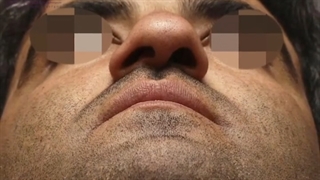 جراحی بینی کج با ‌گرفتگی شدید بینی