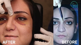 عمل بینی کج و گوشتی