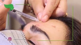 تزریق بوتاکس در ناحیه پیشانی