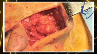 فیلم جراحی توده پاروتید