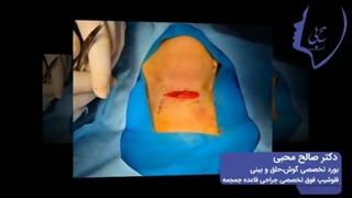 فیلم جراحی کیست تیروگلوس