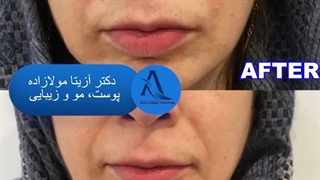 تزریق یک سی سی ژل برای رفع خط خنده
