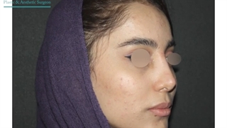 جراحی بینی