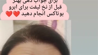 انجام بوتاکس+  نخ لیفت ابرو، گرگان ، ۰۹۳۳۶۰۹۳۰۰۰