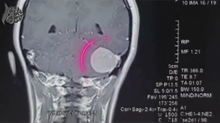 فیلم بدون سانسور جراحی موفقیت آمیز تومور ناحیه حفره خلفی مغز