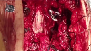 فیلم واقعی جراحی موفقیت آمیز تومور نخاعی