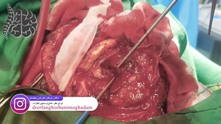 جراحی موفقیت آمیز تومور مغزی