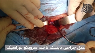 فیلم عمل جراحی دیسک ناحیه سرویکو توراسیک