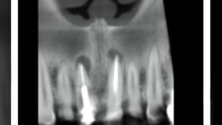 ایمپلنت گذاری فوری ناحیه زیبایی همراه با پیوند بافت استخوان و لثه