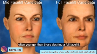 عمل زیبایی لیفت midface