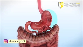آندوسکوپی اسلیو معده