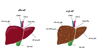 کبد چرب