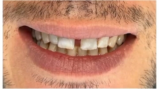 کامپوزیت ونیر چهار دندان قدامی