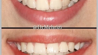 ارتودنسی با کشیدن 4 دندان | دکتر احسان ابوئی مهریزی