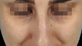 نتیجه یک سال بعد از جراحی بینی