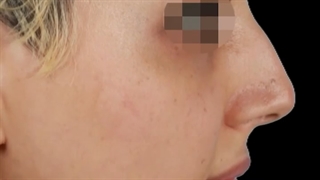 جراحی بینی استخوانی و کج، بلافاصله بعد از عمل