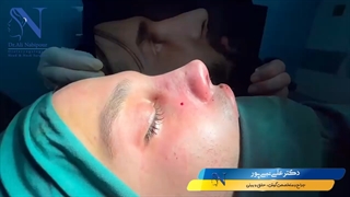 بلافاصله بعد از اتمام جراحی بینی