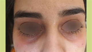 تزریق فیلر زیر چشم