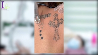 بهترین و مطمئن ترین روش برای پاک کردن تتو