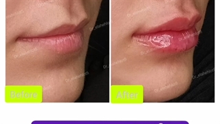 فیلم تزریق فیلر لب