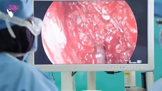 فیلم بدون سانسور جراحی سینوزیت قارچی