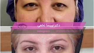 فیلم واقعی از بلفاروپلاستی پلک فوقانی