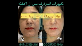 لیفتینگ و جوانسازی پوست با دستگاه پزشکی Aphrodite