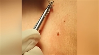 علل منگوله های پوستی اصلاح فرم صورت