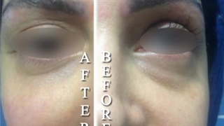 تزریق فیلر زیرچشم