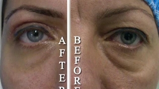 بلفاروپلاستی پلک