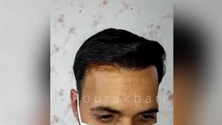 نتیجه کاشت مو بعد از ۹ ماه، گرگان، ۰۹۳۳۶۰۹۳۰۰۰