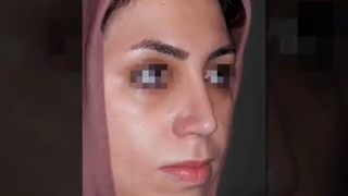 جراحی بینی غضروفی