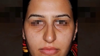 جراحی زیبایی بینی گوشتی به صورت طبیعی