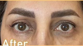 نتیجه جراحی بلفاروپلاستی چهار پلک