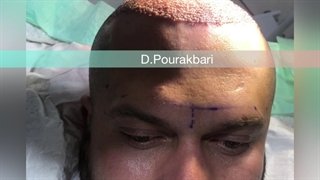 نتیجه کاشت مو در نگین گرگان ۰۹۳۳۶۰۹۳۰۰۰