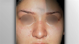 دوازده سال بعد از جراحی زیبایی بینی | دکتر خوروش