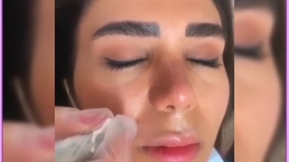 آشنایی با همه روش های لیفت لب به همراه عکس